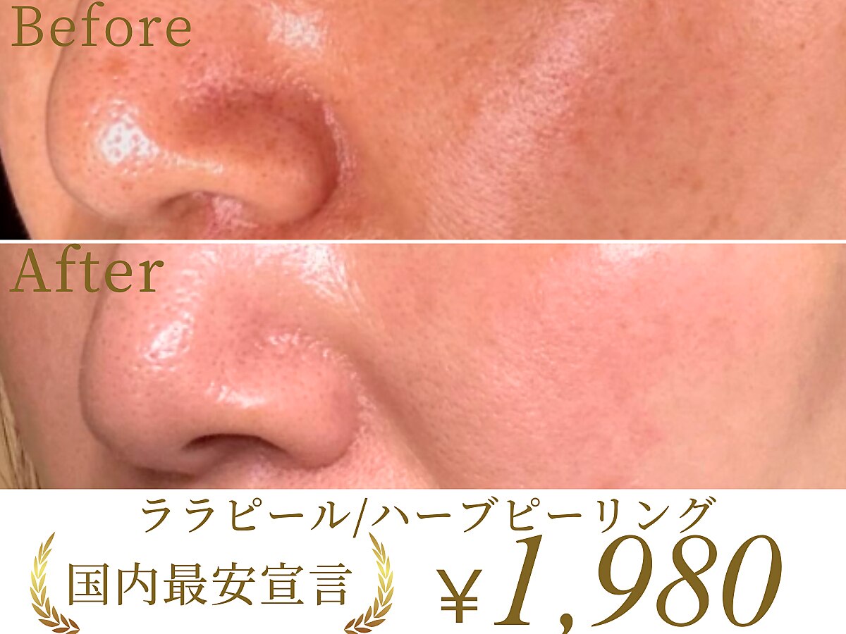 ハーブピーリング ニキビに関するエステサロン 南青山コスメクリニック