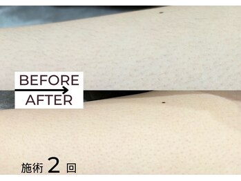 ベガ(Vega)/レディースLED脱毛