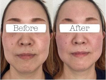 ホリスティックラボ(Holistic Labo)/Before & Afte((フェイスライン)