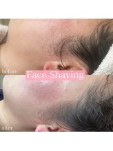 リンド エステ まつげ 京成大久保(Lind)/フェイスシェービング