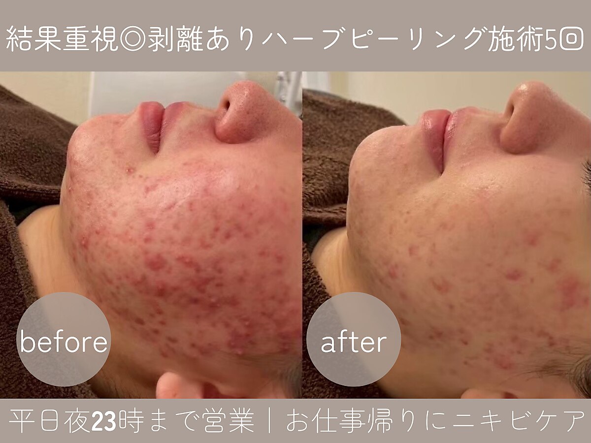 ハーブピーリング 剥離ありに関するエステサロン 美肌ケアサロンiru