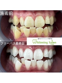 ホワイトニングサロン 札幌店/【ホワイトニング】#札幌#大通り