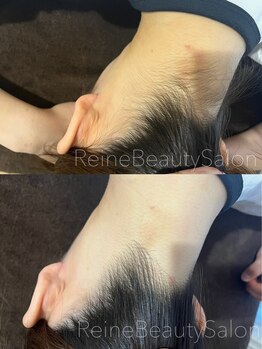 レーヌ(Reine)/うなじえりあし脱毛