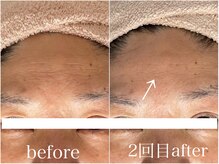 ルー ハナレ 神戸岡本 摂津本山店(Luu HANARE)/おでこシワ改善　２回　幹細胞