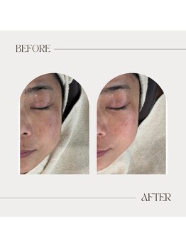 カラット(CARAT)/光フェイシャル