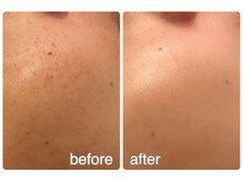 ラディアンス/シミケアフェイシャル　BA