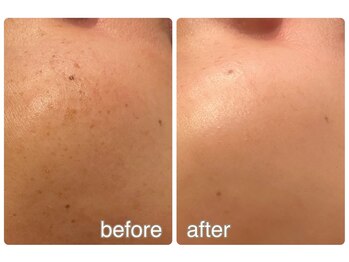 ラディアンス/シミケアフェイシャル　BA