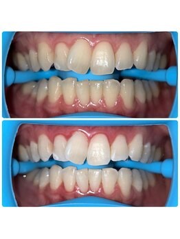 コナホワイトニング 神保町/御茶ノ水ホワイトニング