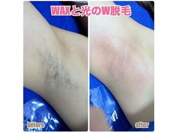 ラフォクシー(La.Foxy)/脇W脱毛