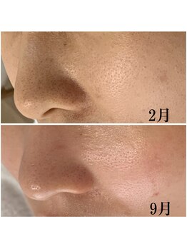 プラセル(Placer)/6か月の変化