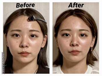ショウフェイスデザイン(Sho Face Design)/《小顔矯正》ビフォーアフター