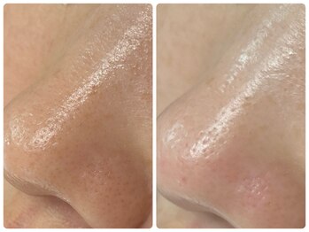 カピリナ(ka pilina)/ザラつき解消！毛穴ケア★