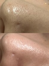 アットウィル 志木店(at will)/超音波ピーリングBefore After