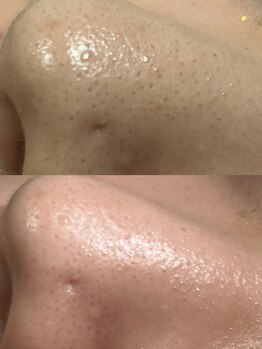 アットウィル 志木店(at will)/超音波ピーリングBefore After