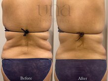 ウナ 西中島店(UNA)/当店人気No.1脂肪冷却(４カップ)