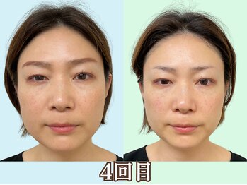 ナチュラルパーフェクトフェイス 新宿/4回目/頬骨改善/新宿小顔矯正