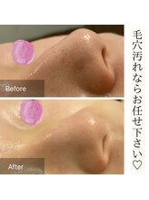 モナ 宝塚店(Mona)/一回目から凄い！毛穴ハイドロ♪