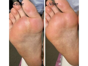 ウォーク(Walk)/#魚の目#タコ#足裏角質#足爪