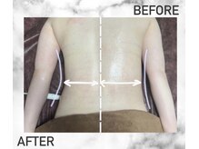 メロス/筋膜リリース１回効果