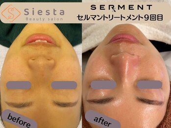 シエスタ(siesta)/セルマン９回目（bf→af）
