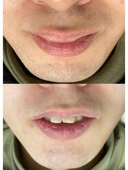 ジェムの森/ひげ脱毛 before after写真