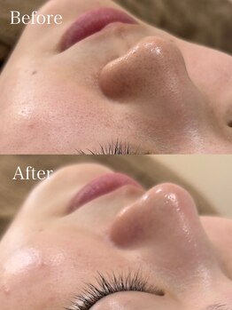 ミュー 岡崎店(mieux)/◇毛穴洗浄で黒ずみ対策