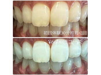 ホワイトニングルーム 横浜店(Whitening Room)/ホワイトニング/横浜