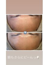 エマ(ema)/水光生美容液導入トリートメント