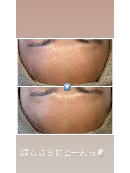 エマ(ema)/水光生美容液導入トリートメント