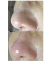 ミント/毛穴コースツヤツヤ鼻