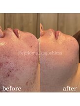 エピロマ(EPILOMA)/鹿児島市/宇宿/肌質改善