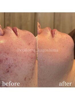 エピロマ(EPILOMA)/鹿児島市/宇宿/肌質改善