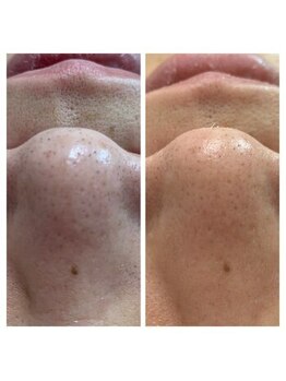 アンジェリーナ/毛穴洗浄/メンズ美容