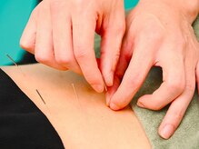 きりん接骨鍼灸院 尼崎武庫之荘店/腰の鍼施術（腰痛、妊活）