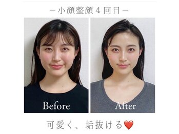 マナレア(Manalea)/別人級小顔整顔！