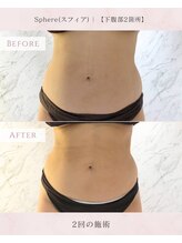スフィア(Sphere)/ビフォアフ：脂肪冷却