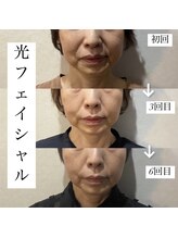 アース コアフュールボーテ 新潟紫竹山店(EARTH coiffure beaute)/光フェイシャル