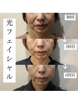アース コアフュールボーテ 新潟紫竹山店(EARTH coiffure beaute)/光フェイシャル