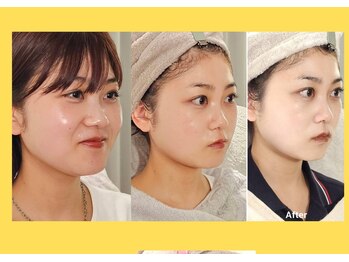 アン 銀座(ann)/レモンボトル0~2回目