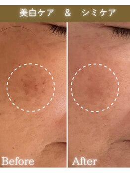 ココロ(COCORO)/シミケア3回 ビフォーアフター