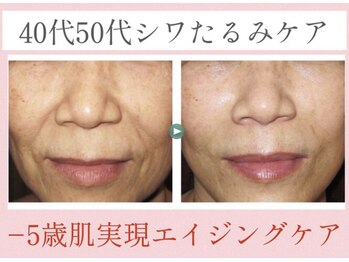 デュモンド(dumonde)の写真/４０代以降のお肌のたるみにお悩みの女性のための【極上フェイシャル】
ハリ・フェイスラインスッキリ！！