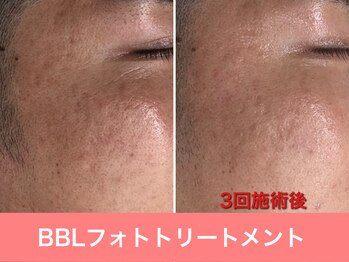 ミスターアンクール 鹿児島(Mr.uncoeur)/フォトトリートメント3回施術後