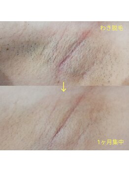 RiとBiのたまご/（速効脱毛）　ワキ脱毛