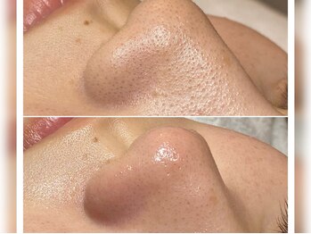 プライベートエステティックサロン クール(Coeur)/【毛穴汚れ角栓吸引コース】