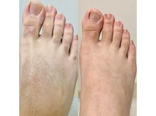 ジェムの森/足脱毛 before after写真