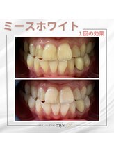 ミースホワイトニング(mys whitening)/ビフォーアフター【歯科提携】