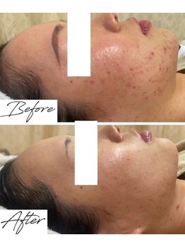 ビズビズ 梅田店(bisebise)/梅田ハーブピーリング/ニキビ