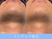 オーシャンブルー 大分店(OCEAN BLUE)/メンズヒゲ脱毛