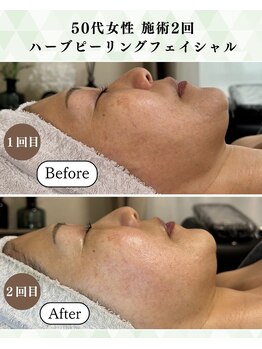 シーフェイス 横浜店(SEE FACE)/剥離×ハーブピーリングモニター