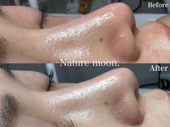 ナチュールムーン(Nature moon.)/毛穴洗浄